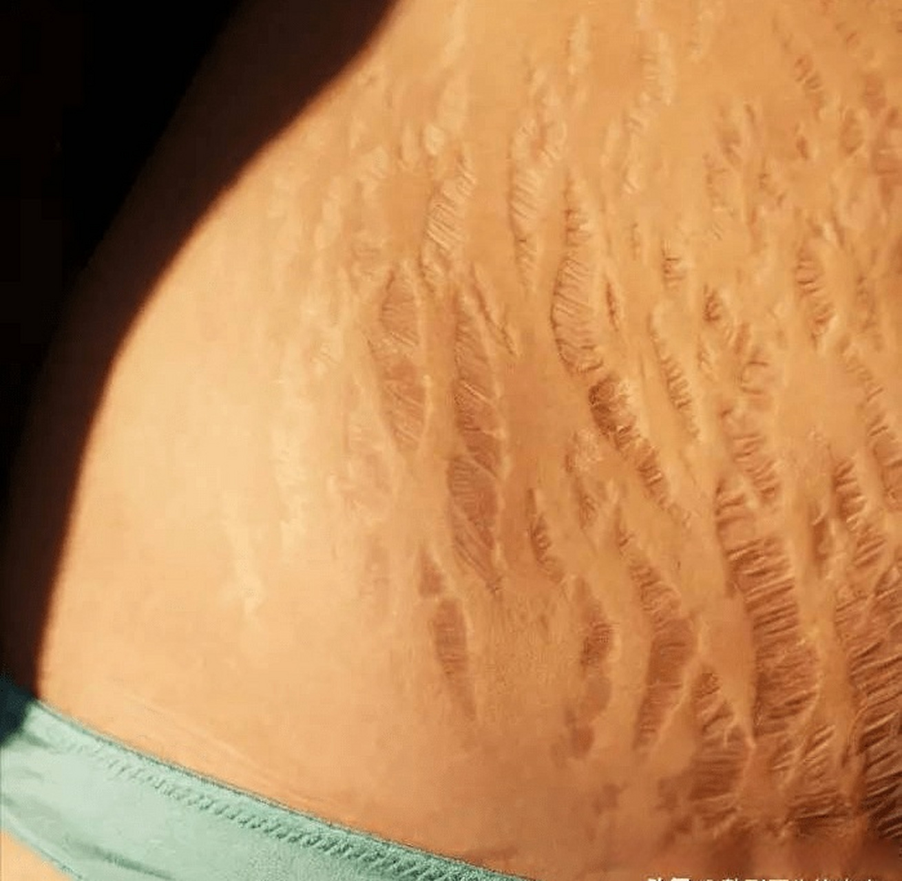 最严重的妊娠纹图片,最严重的妊娠纹图片欣赏