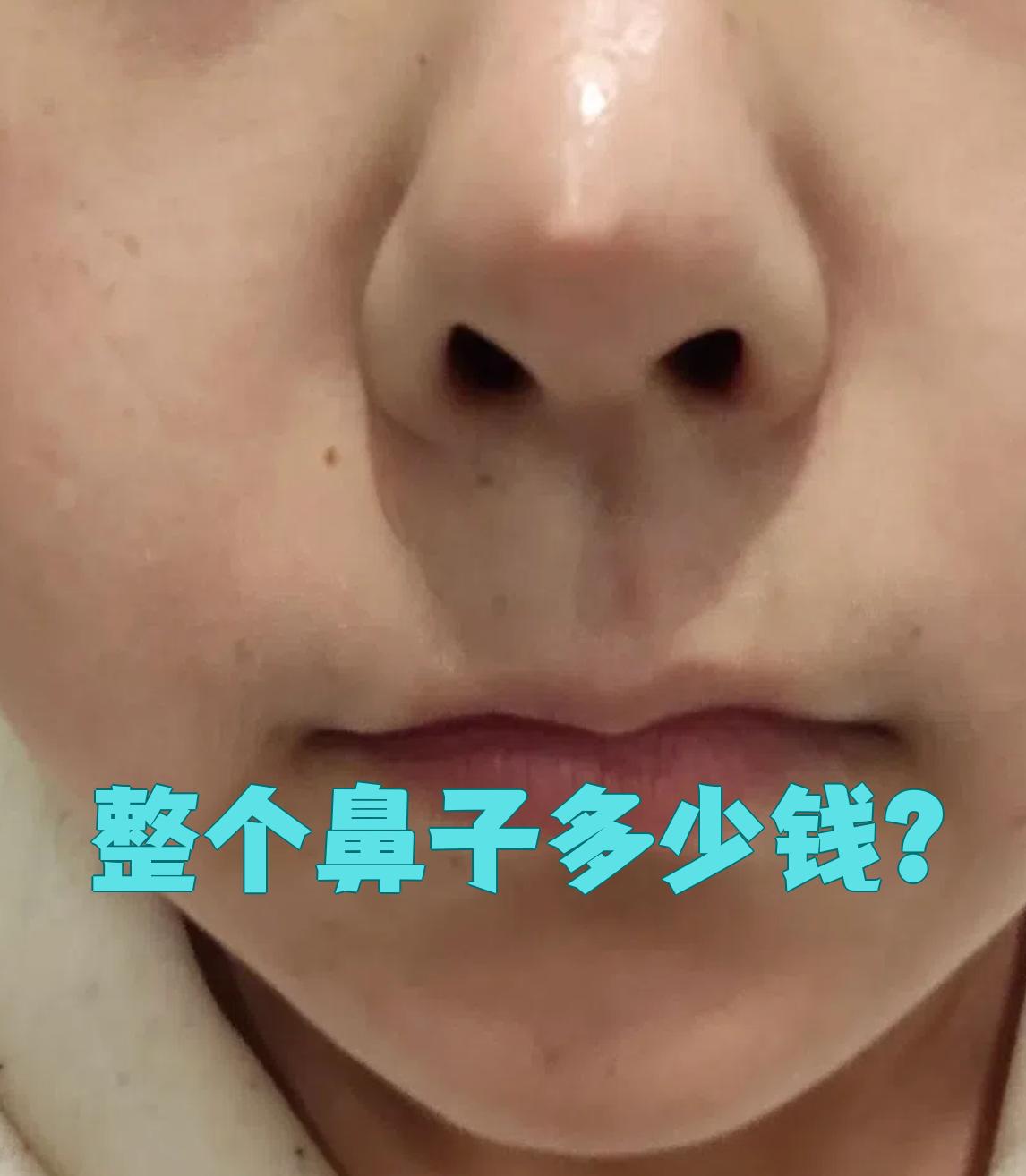 隆鼻多少钱?,乳白天使注射隆鼻多少钱
