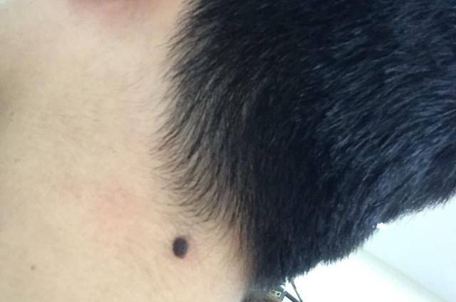 脖子后面有痣代表什么用意,