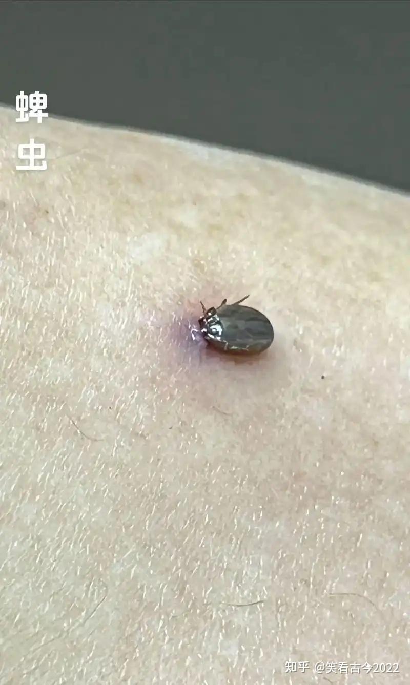 梦见自己身上有虫子,梦见自己身上有虫子爬是什么意思